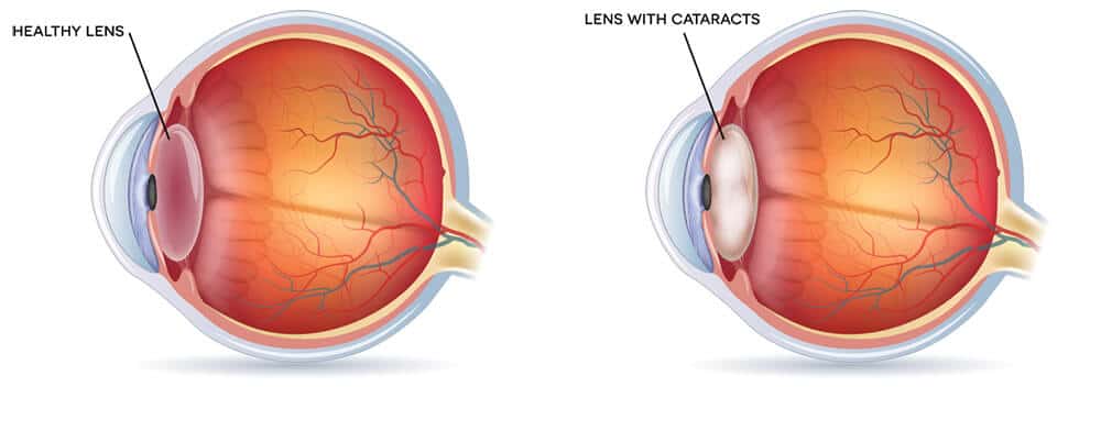 Chart Illustrating a Healthy Lens Vs One With a Cataract