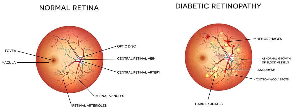 Chart Illustrating a Normal Retina Compared to One Experiencing Diabetic Retinopathy