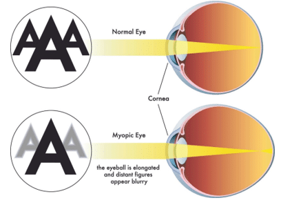 Chart Illustrating a Normal Eye Compared to a Myopic Eye