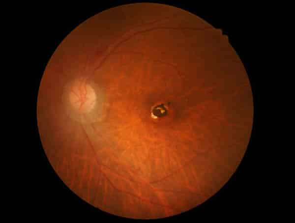 Scan of an Eye With a Macular Hole