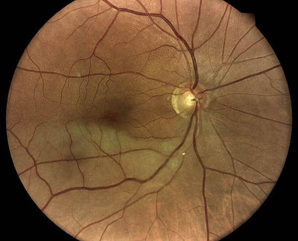 Scan of an Eye With Retinal Artery Occlusion