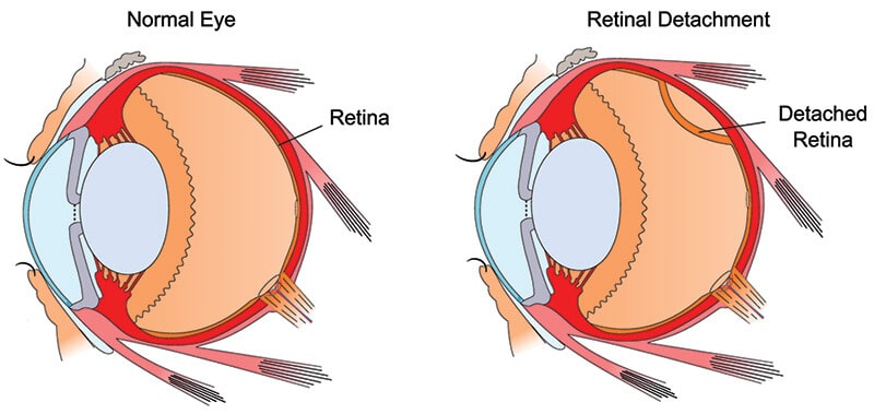 Illustrating a Normal Eye Compared to One With Retinal Detachment