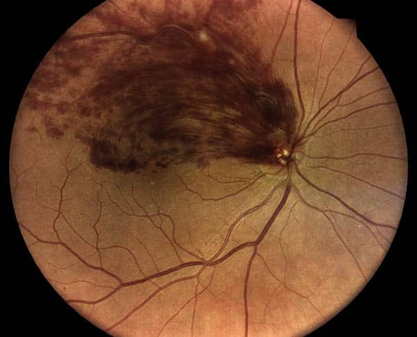 Scan of an Eye With Retinal Vein Occlusion